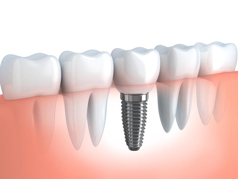 Dental Implants  Wilmette, IL 
